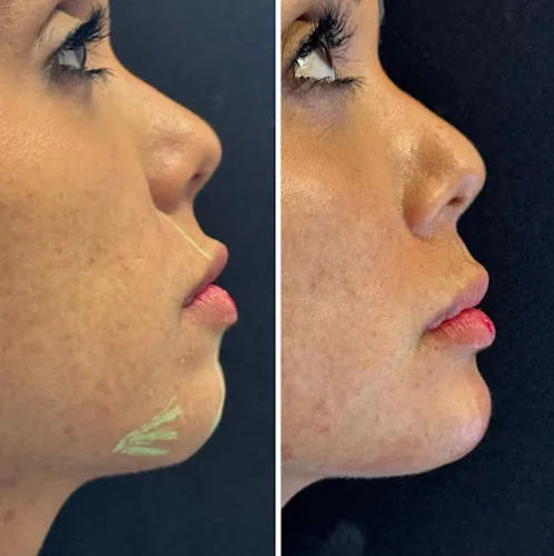 Comparativo de perfil em tratamento de harmonização facial